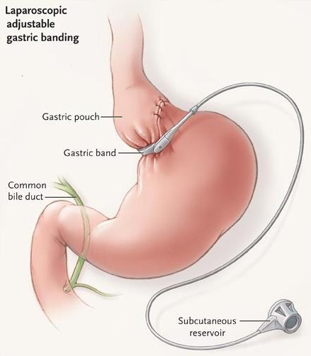 Image of adjustable gastric band (AGB) - bariatric surgery
